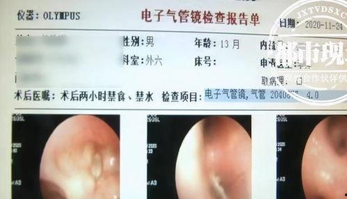 宝宝吃瓜呛到咳嗽,家长如何应对与预防